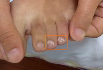 灰指甲反复发病的原因是什么